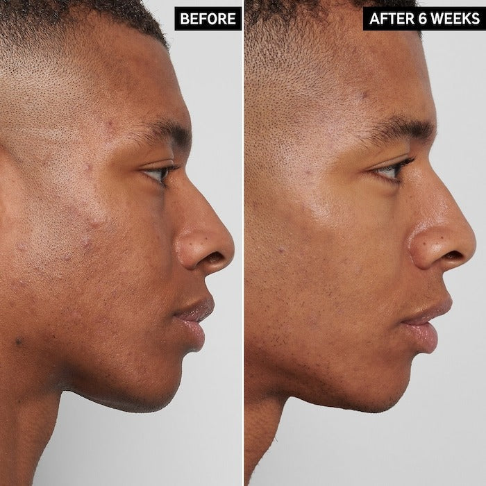 The Inkey List Dark Spots and Acne and Blemishes- 0.5 oz/15 ml